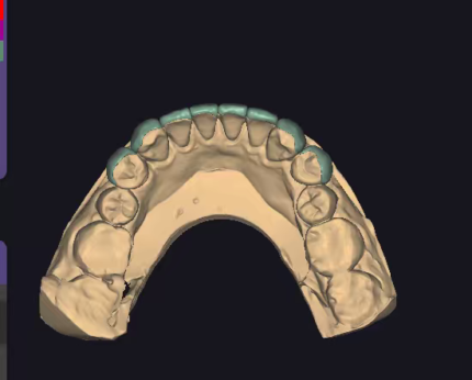 Clear Aligner Setup