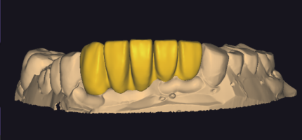 Crown & Bridge & Veneer