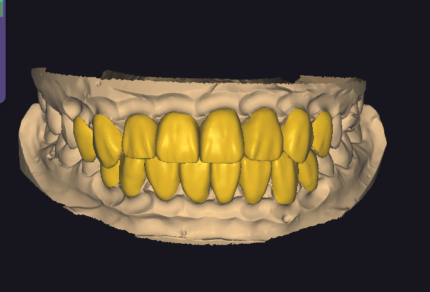 Surgical Guide Design