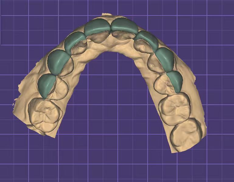 Aesthetic Veneers