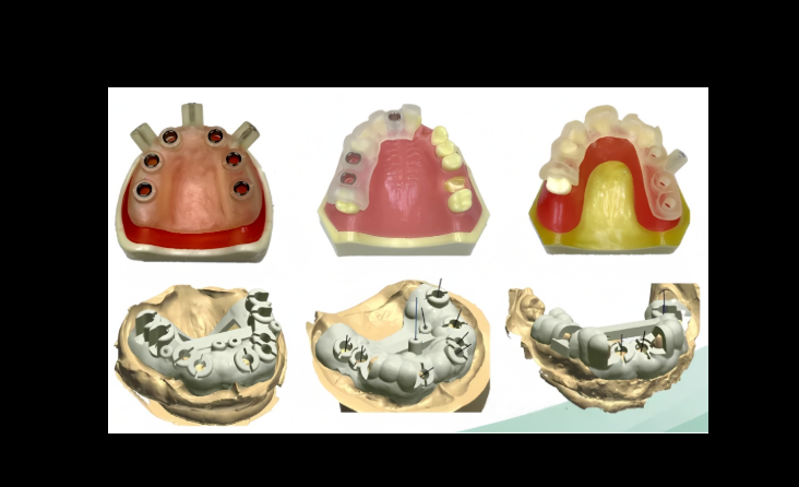 Surgical Guide Design