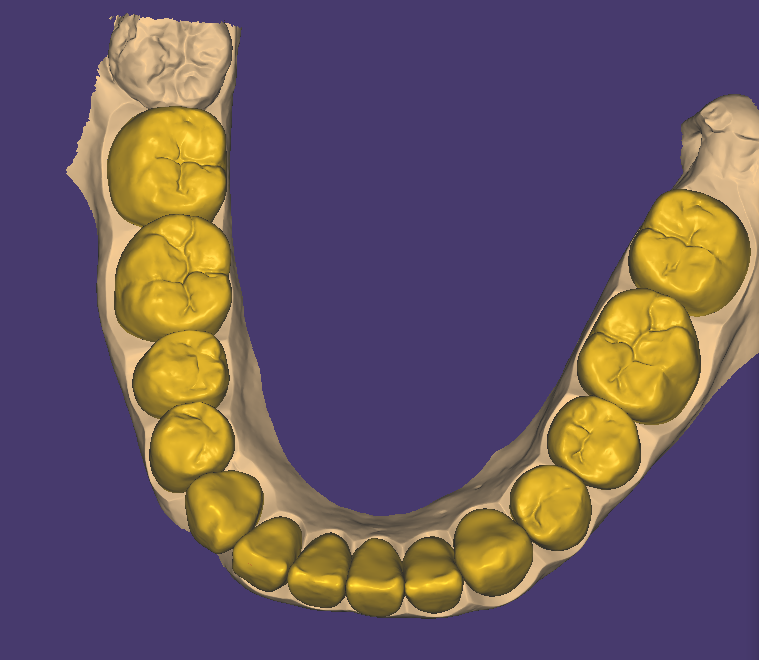 Crown & Bridge & Veneer