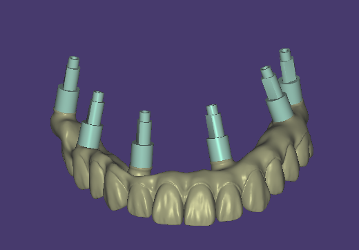 Implant Bar & Abutment Design